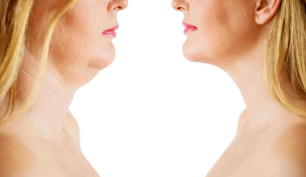 Double Chin treatment Sedgley Park before and after results