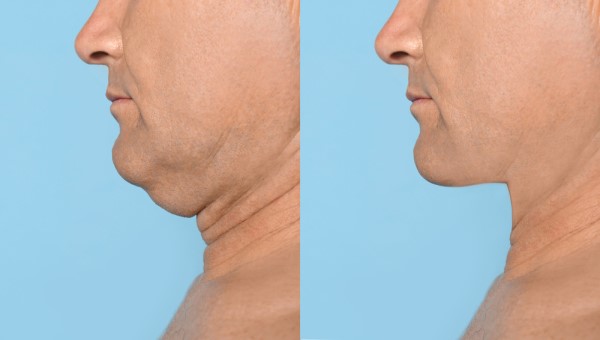 Which Non-Surgical Treatments Work Best for Jowls and Loose Skin Sedgley Park?