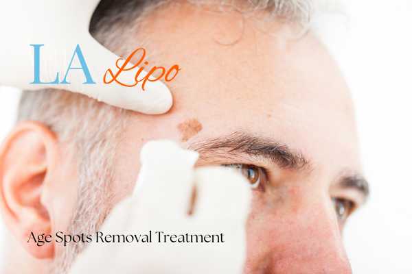 What Are the Most Effective Treatments for Age Spots Sedgley Park?