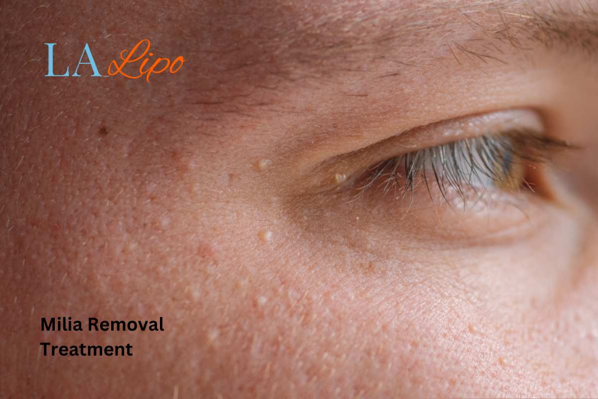Cryopen Milia Removal: Is It the Easiest and Safest Option Sedgley Park?