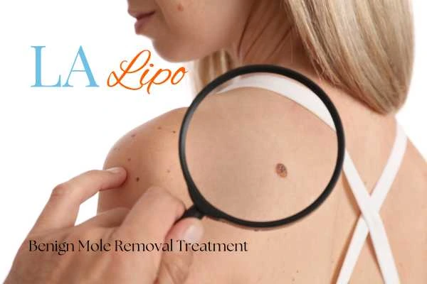 Woman having her inspection of blemish before mole removal Sedgley Park