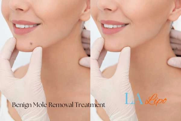 woman's before and after mole removal Sedgley Park results