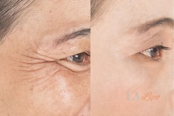 Before and after results of woman - HI-fu wrinkles reduction treatment Sedgley Park