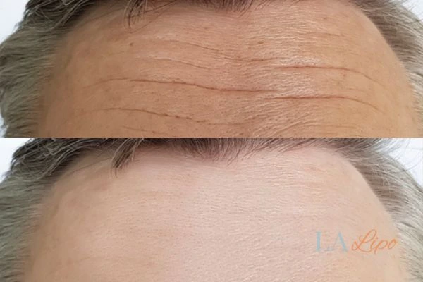 results of HIFU Sedgley Park on mans forehead to help reduce lines and wrinkles