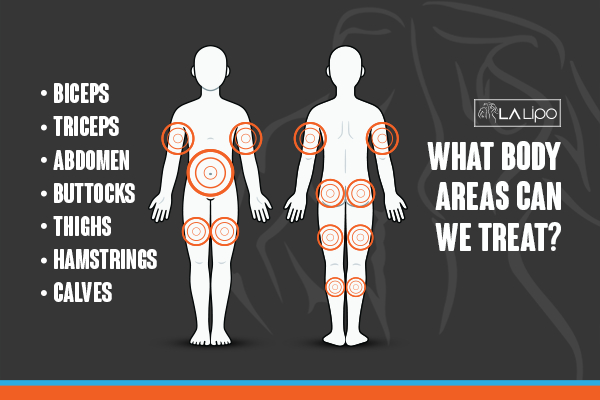 Graphic to show areas you can have LA-EMS Body Sculpting Sedgley Park treatment.