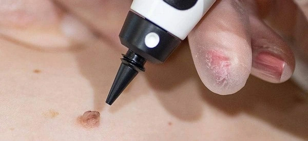 skin tag removal using cryopen Sedgley Park