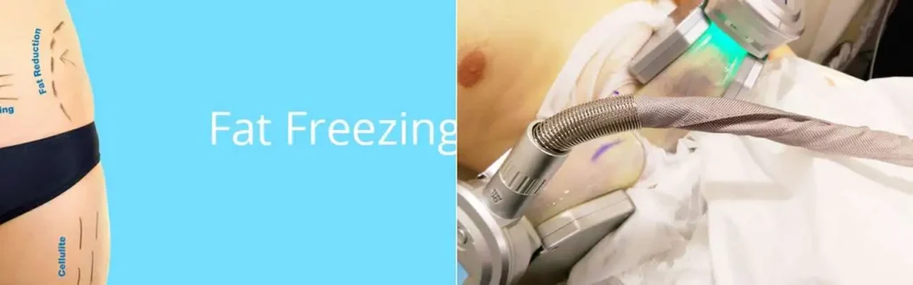 multi areas of a persons body having coolsculpting Sedgley Park treatment