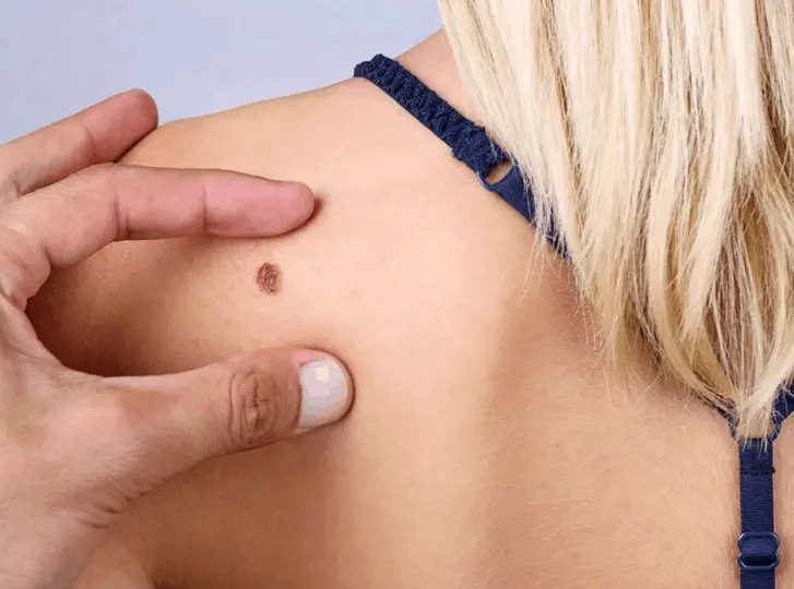 woman having mole removal Sedgley Park consultation before treatment.