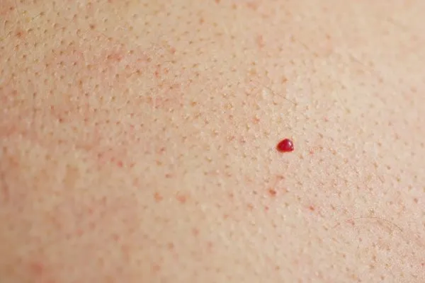 close up of a cherry angioma Sedgley Park