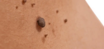 image of a skin tag Sedgley Park