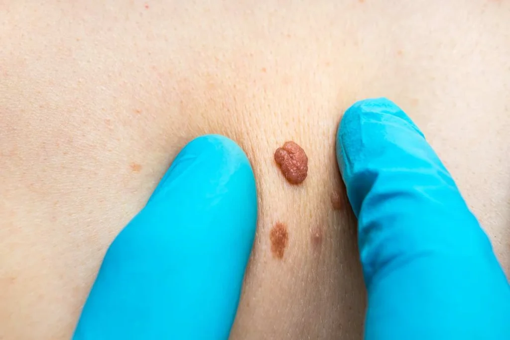 Consultant examining a skin tag Sedgley Park