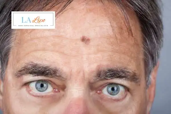 Solar Lentigo Removal Sedgley Park image of man with mark on his forehead