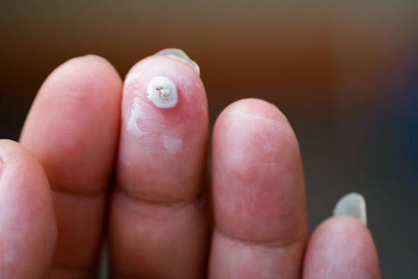 wart on person finger - cryotherapy to treat from LA LIPO Sedgley Park