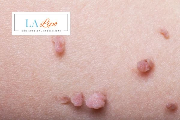 Does cryopen skin tag removal Sedgley Park hurt? Find out now call our team today!