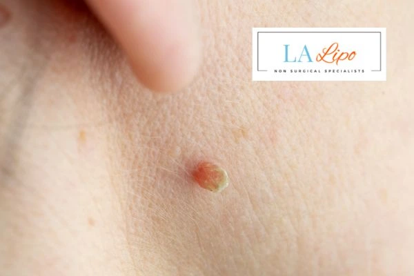 Book skin tag removal Sedgley Park today speak to our team now!