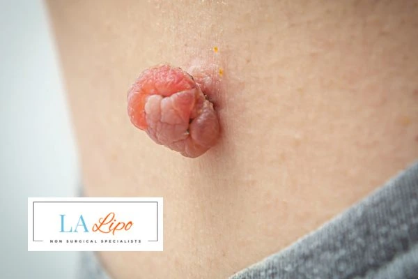 Interested in skin tag removal Sedgley Park? Concerned about the pain? Find out more today!