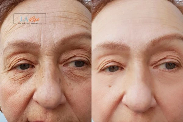 The powerful benefits of Morpheus8 Treatment Sedgley Park - Call Our team today!