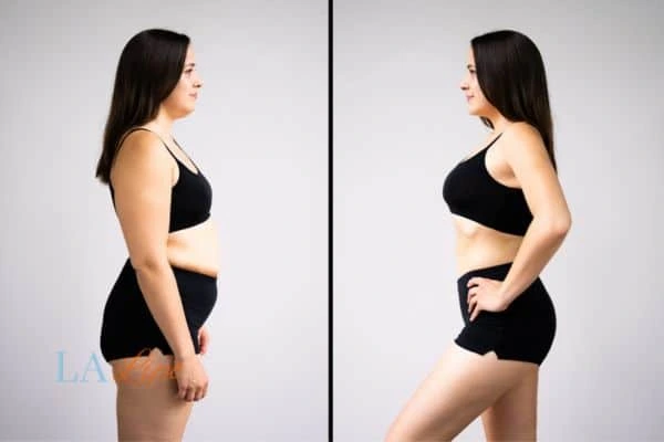 Picture of womans before and after using LA-EMS body sculpting to improve her core strength Sedgley Park