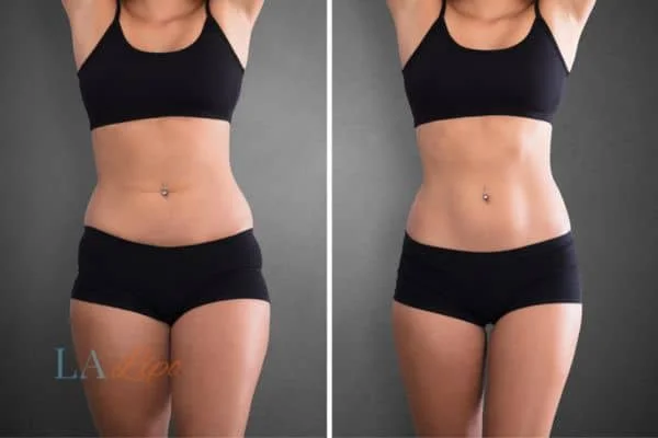 before and after results of non-surgical treatment to help a woman's body image and mental health Sedgley Park