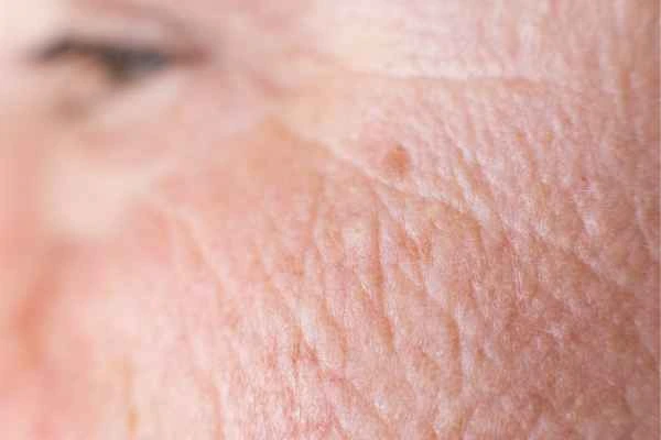 close up picture of a woman's face showing an age spot Sedgley Park