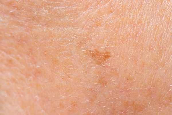 close up picture of age spots Sedgley Park