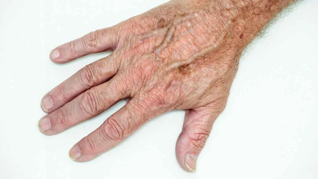 Male hand showing age spot Sedgley Park