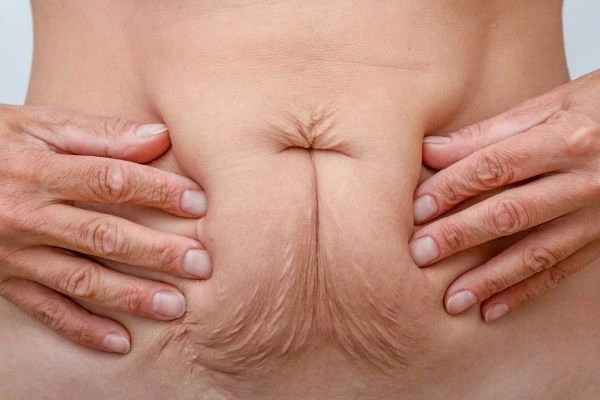 Image of a woman's stomach with loose skin - example of skin tightening Sedgley Park options