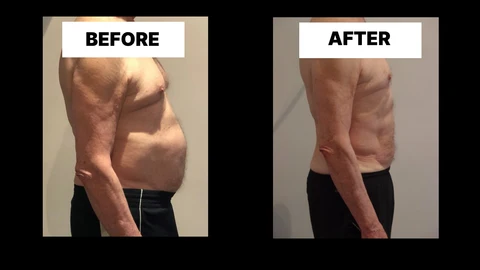 What Symptoms Can Diastasis Recti Cause in Men? Weak Core, Back Pain and Poor Posture Sedgley Park